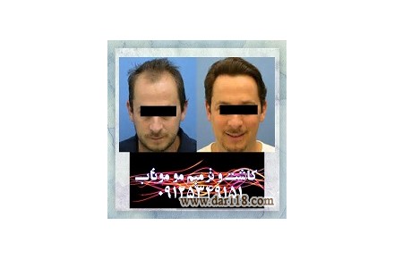 کاشت و ترمیم مو - 1