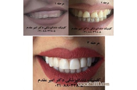 دندانپزشک ملاصدرا دکتر امیر مقدم  02188032805 لامینیت دندان،ایمپلنت دندان،اصلاح طرح لبخند،کاشت دندان - 1