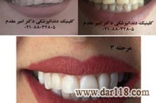 دندانپزشک ملاصدرا دکتر امیر مقدم  02188032805 لامینیت دندان،ایمپلنت دندان،اصلاح طرح لبخند،کاشت دندان