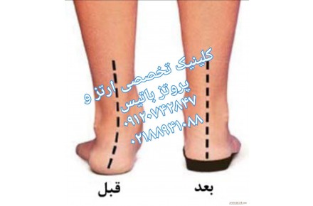 صافی کف پا - 2