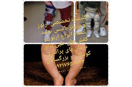 درمان پای پرانتزی در کودکان و بزرگسالان - 1