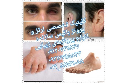 پروتزهای زیبایی - 1
