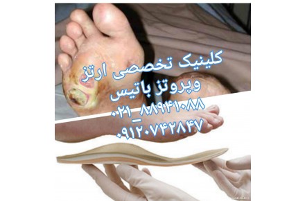 درمان زخم های پای دیابتی با کفش دیابتی و کفی دیابتی