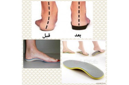 درمان صافی کف پا با استفاده از کفش طبی و کفی طبی - 3