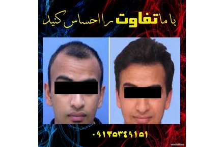 کاشت مو