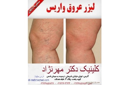 لیزر تخصصی واریس - 1