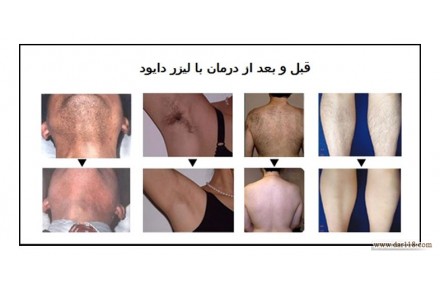 زیبایی و لیزر - 2