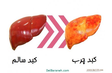 درمان قطعی کبد چرب ، بیماری خاموش! - 2