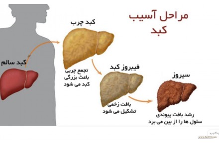 درمان قطعی کبد چرب ، بیماری خاموش! - 3