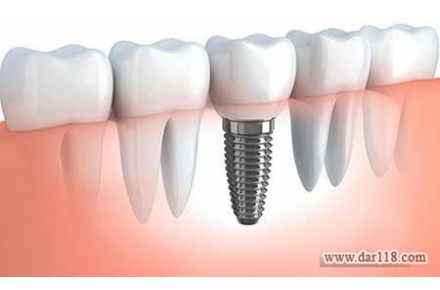 ایمپلنت کره ای و اروپایی  - تصویر شماره 3