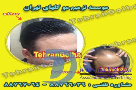 ترمیم مو به روش انحصاری ، های فیکس آلمان (گلهای تهران ) - 1