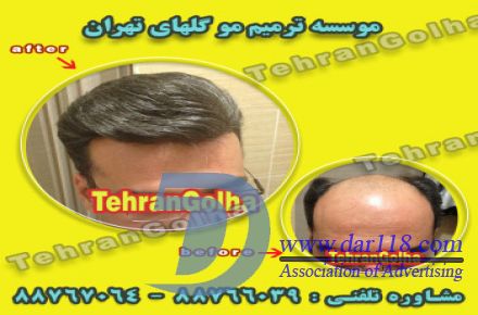 ترمیم مو به روش انحصاری ، های فیکس آلمان (گلهای تهران ) - 2