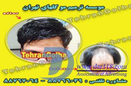 ترمیم مو به روش انحصاری ، های فیکس آلمان (گلهای تهران ) - 3