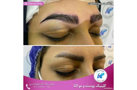 کاشت ابرو مناسب افرادی که ابروهای کم پشتی دارند - 1