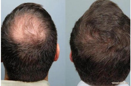 کاشت مو طبیعی با شرایط اقساطی