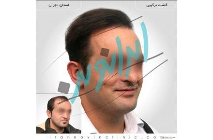 کاشت مو طبیعی با شرایط اقساطی - 2