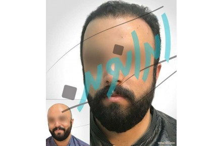 کاشت مو و ابرو با اقساط بلند مدت
