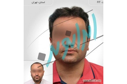 کاشت مو و ابرو با اقساط بلند مدت - 2