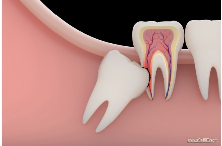 جراحی دندان عقل بی دردسر در کلنیک دکتر سریتا - 1
