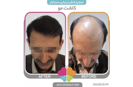 کاشت مو در اصفهان - 1