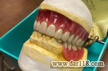 ساخت انواع دندان مصنوعی 