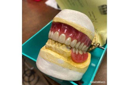 ساخت انواع دندان مصنوعی - 3