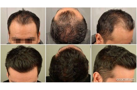 کاشت مو تهرانی | 09126451984 - 1
