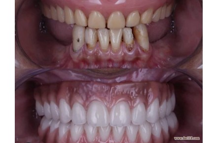 ساخت انواع دندان مصنوعی - 2