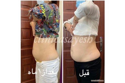لاغری با کرایو لیپولیز - 1
