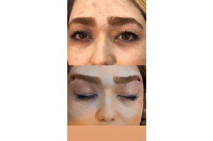 زیبایی نزریق ژل بوتاکس و لیفت با نخ ، مزوتراپی - 2
