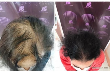 اسکالپ سر میکرو اسکالپ 09011777599 - 1