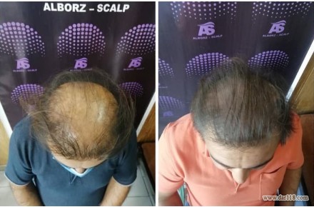 اسکالپ سر میکرو اسکالپ 09011777599 - 2