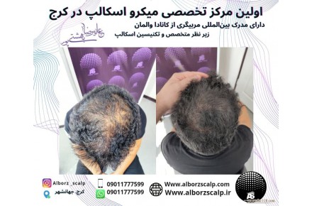 اسکالپ سر میکرو اسکالپ 09011777599 - 3